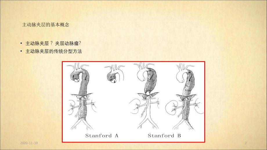 主动脉夹层分型及治疗(最新ppt课件)_第2页