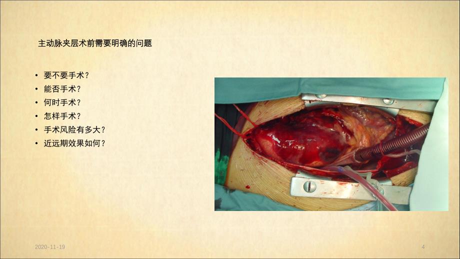 主动脉夹层分型及治疗(最新ppt课件)_第4页