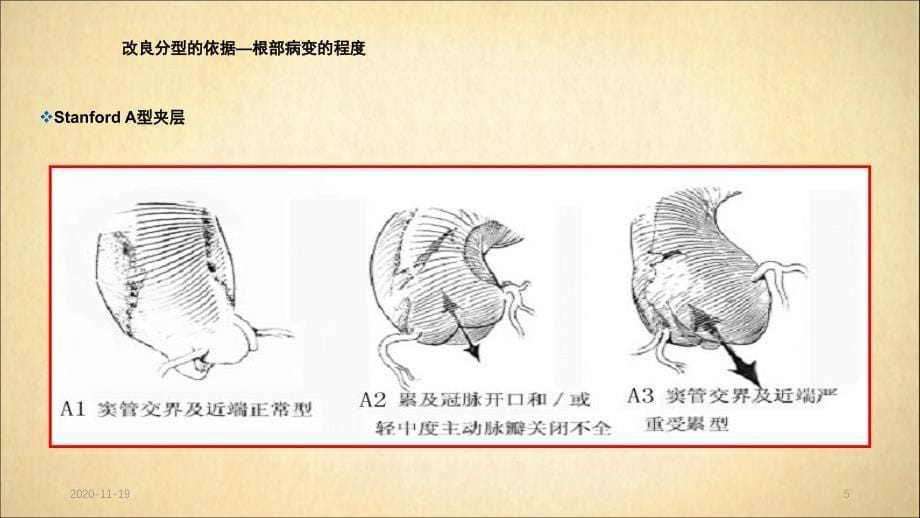 主动脉夹层分型及治疗(最新ppt课件)_第5页