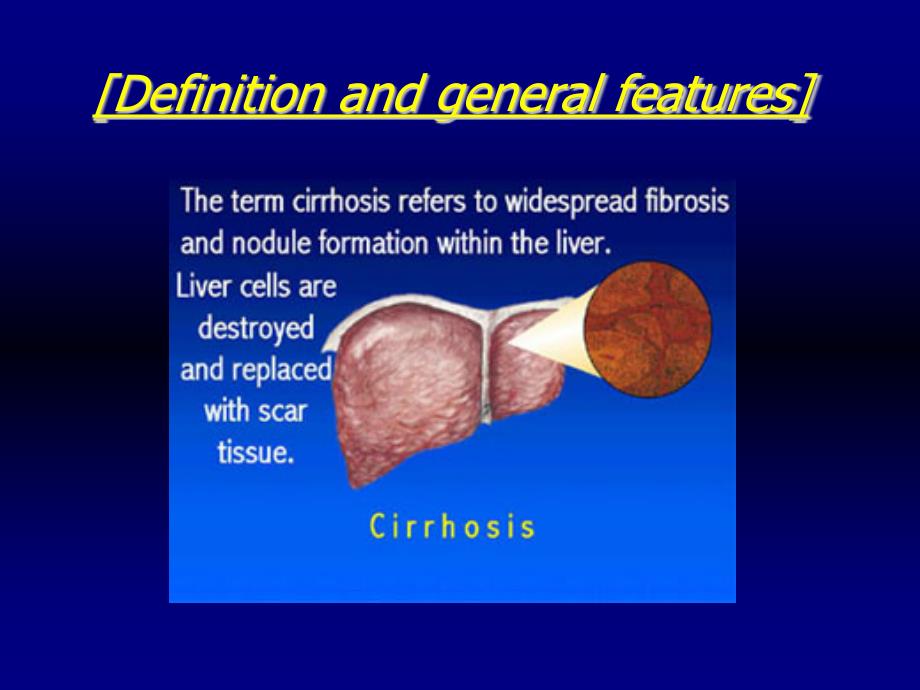 内科学教学课件：Hepatic Cirrhosis肝硬化_第3页