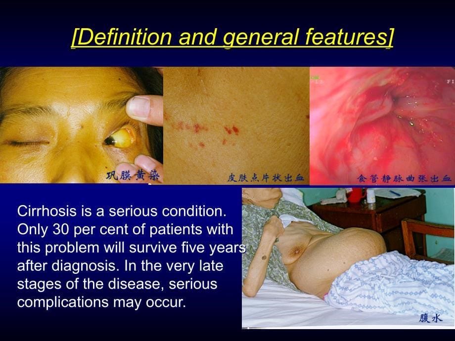 内科学教学课件：Hepatic Cirrhosis肝硬化_第5页