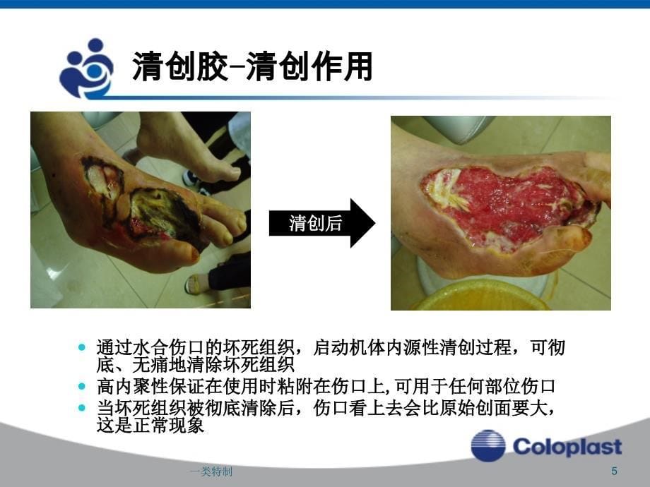 敷料的选择与应用行业研究_第5页