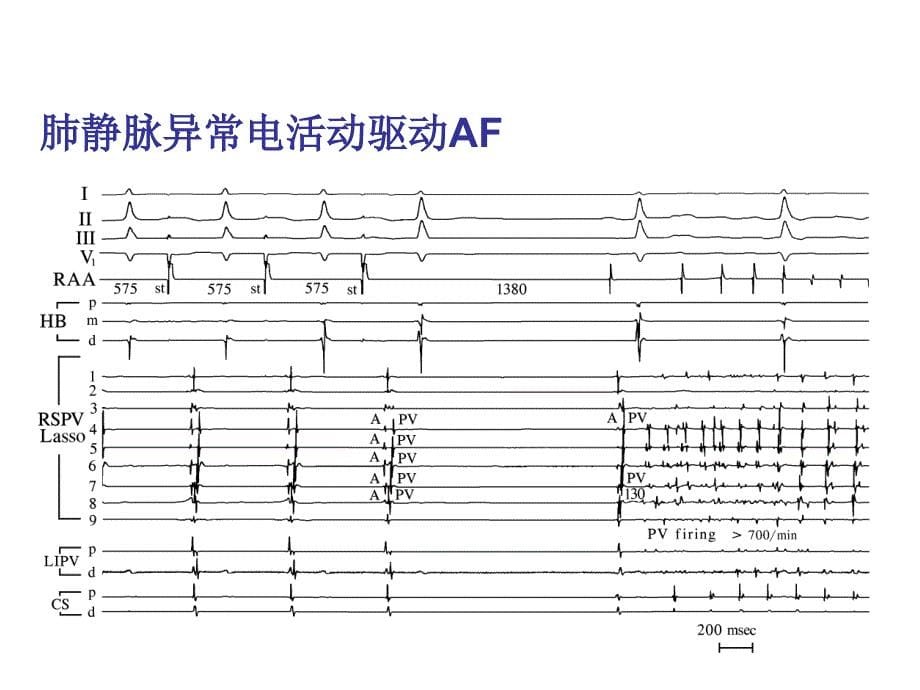 心房颤动的研究现江洪_第5页