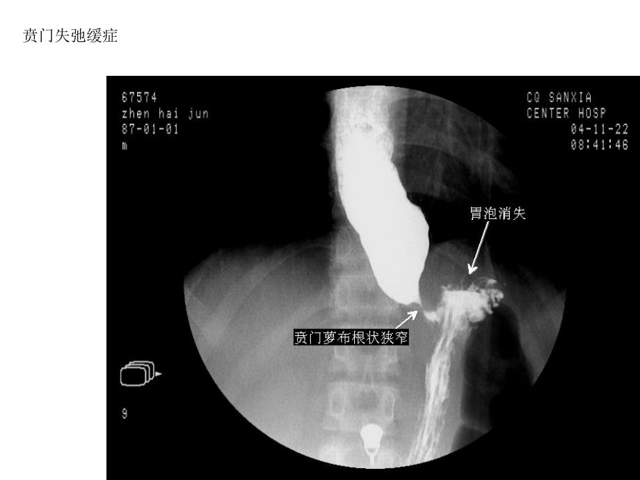 精品全套消化道钡餐图片可编辑_第4页