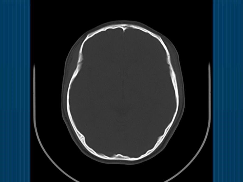 怎么看头颅CT与MRI课件_第5页