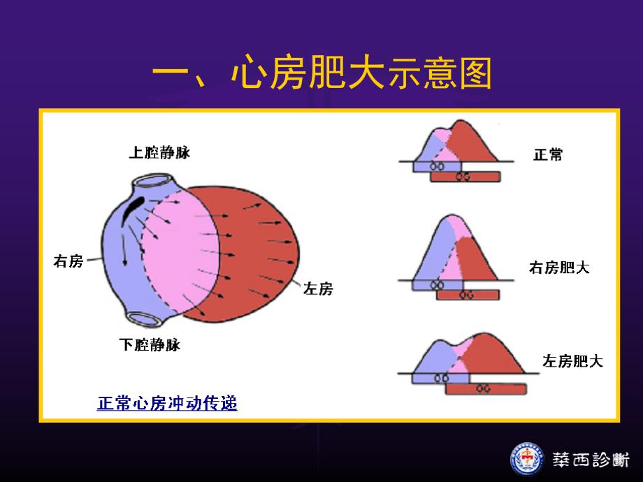 心电图心脏肥大_第3页