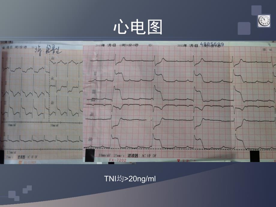 成功救治急性心梗心肺复苏4小时病人2例_第4页