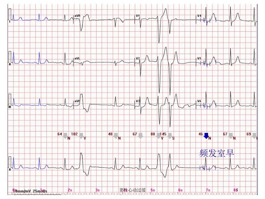 窦性心动过缓培训课件_第5页