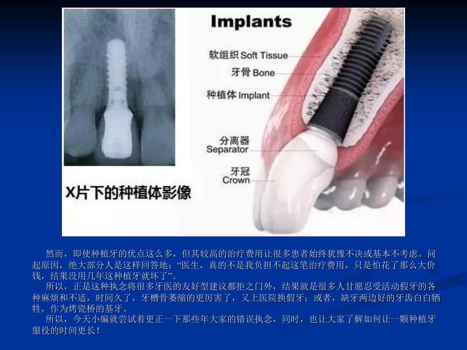 很多人不愿意选择种植牙的真相_第3页