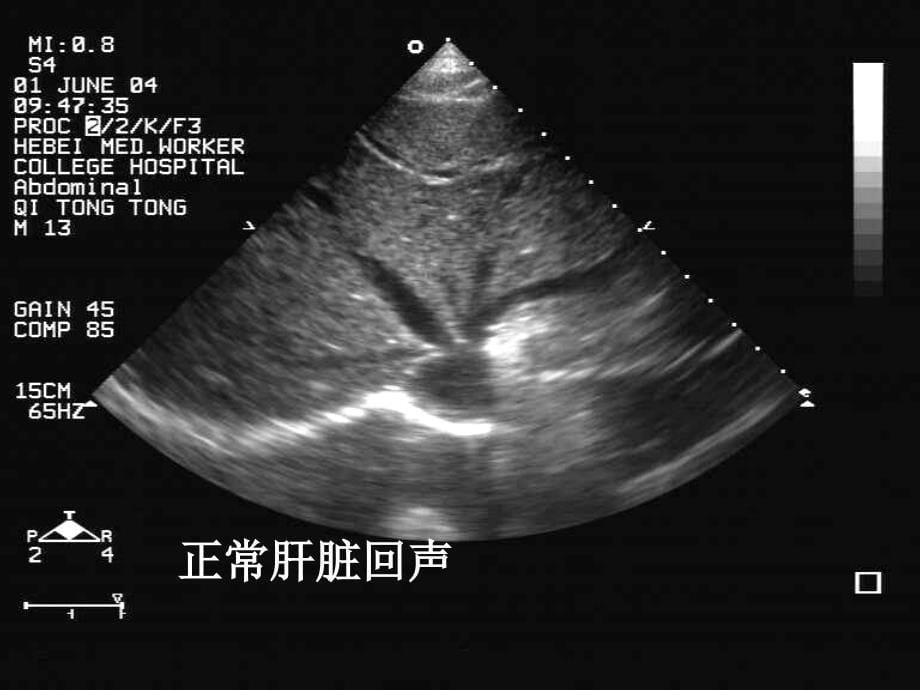 肝脏弥漫性病变PPT课件_第5页