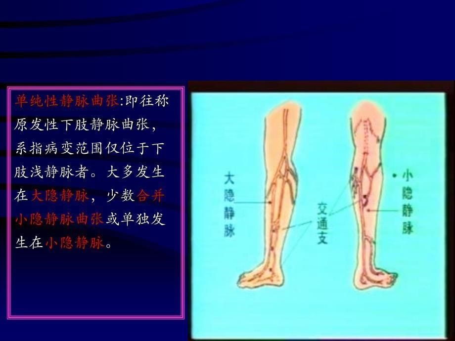 周围血管疾病病人的护理.ppt_第5页