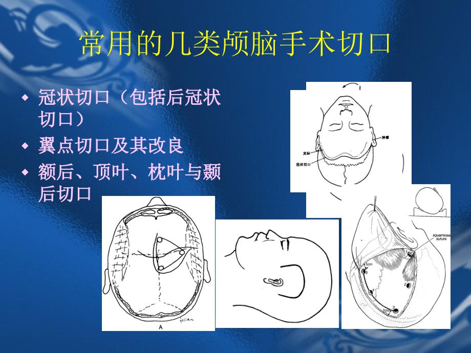 颅脑手术切口的设计原则课件_第2页