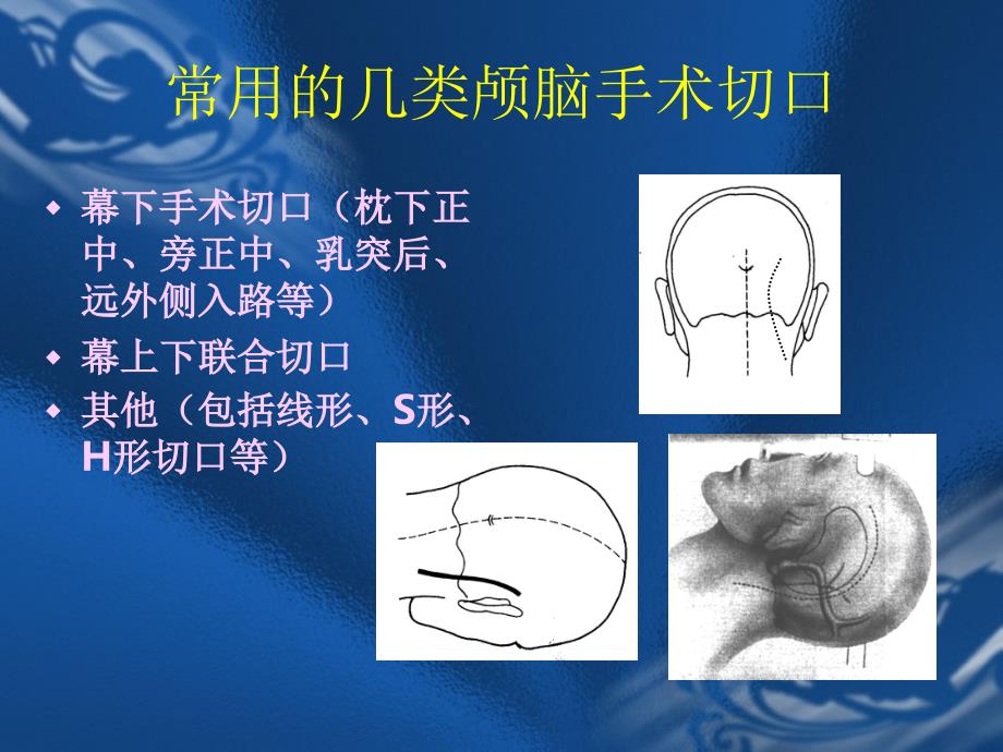 颅脑手术切口的设计原则课件_第3页