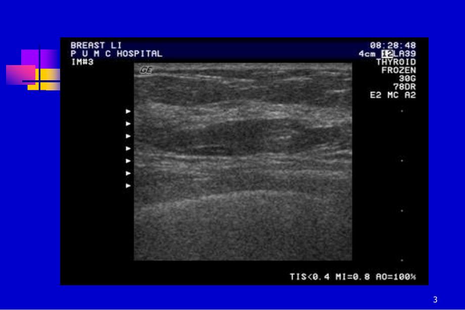 乳腺超声ppt课件_第3页