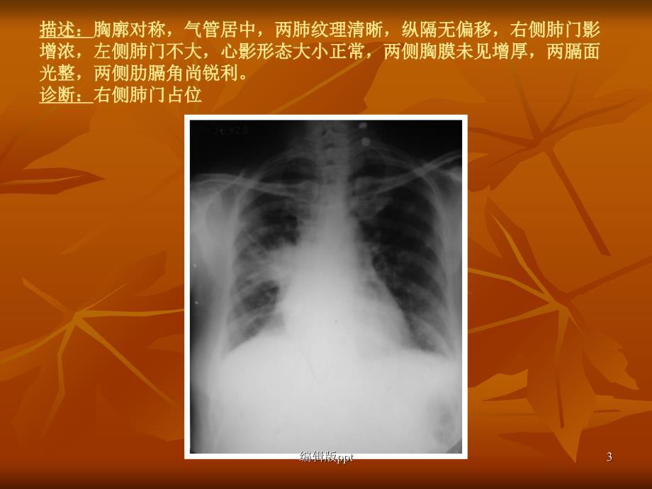 常见X片读片及诊断医学PPT课件_第3页