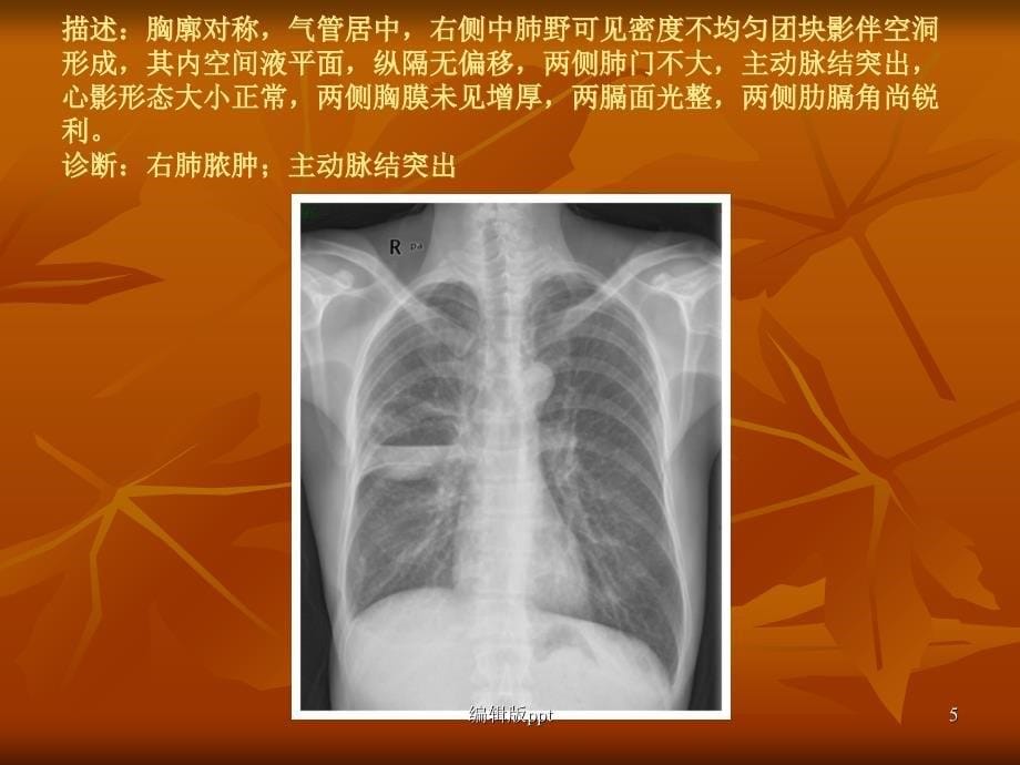 常见X片读片及诊断医学PPT课件_第5页