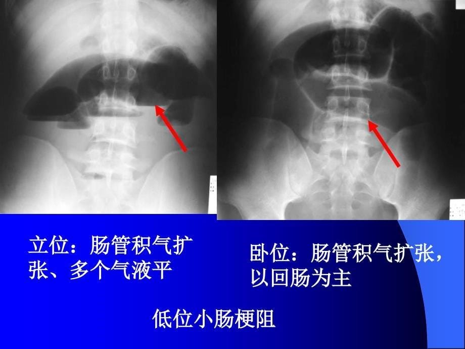 消化系统影像学课件_第5页