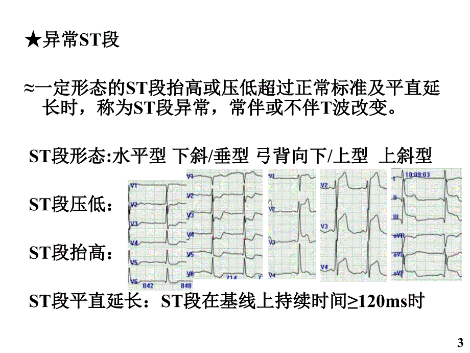 缺血性胸痛时的动态心电图表现_徐金义_第3页