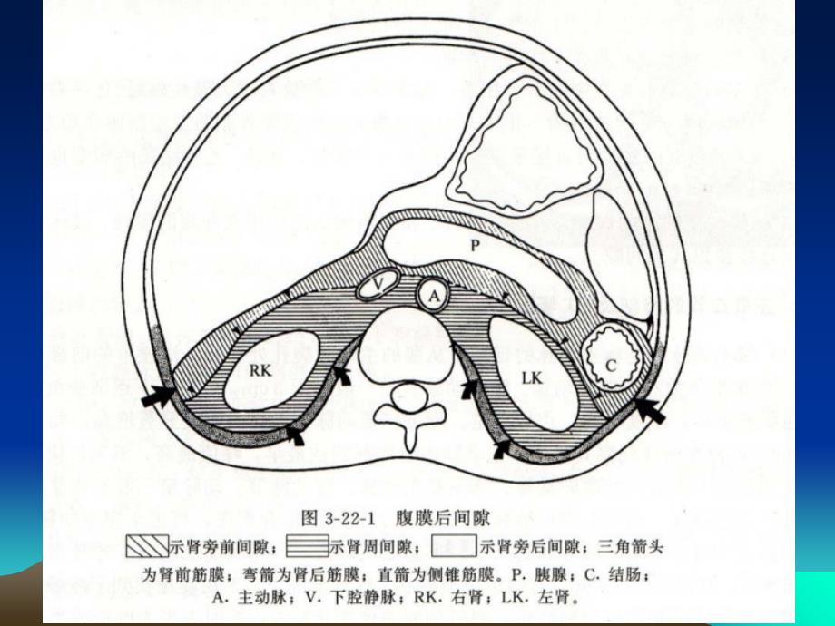 原发性腹膜后肿瘤CT诊断_第4页