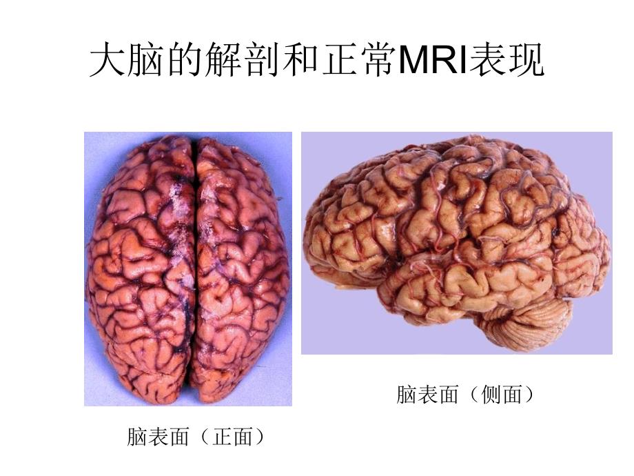 大脑的解剖和正常mri表现_第1页