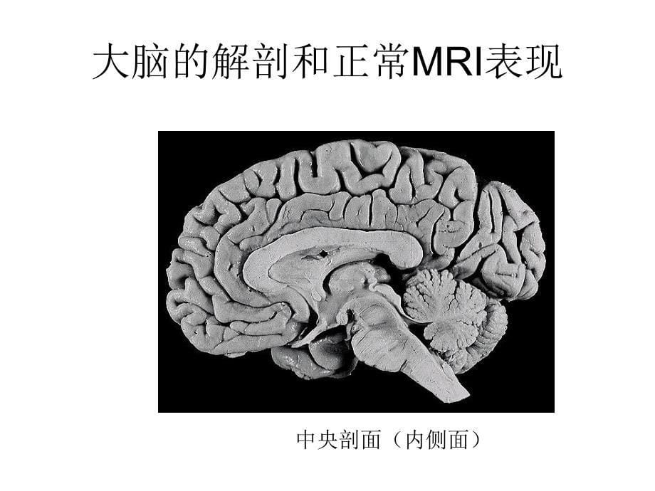 大脑的解剖和正常mri表现_第5页