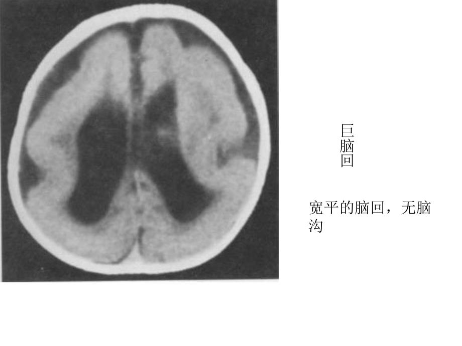 《畸形与脑血管》PPT课件教学文案_第2页