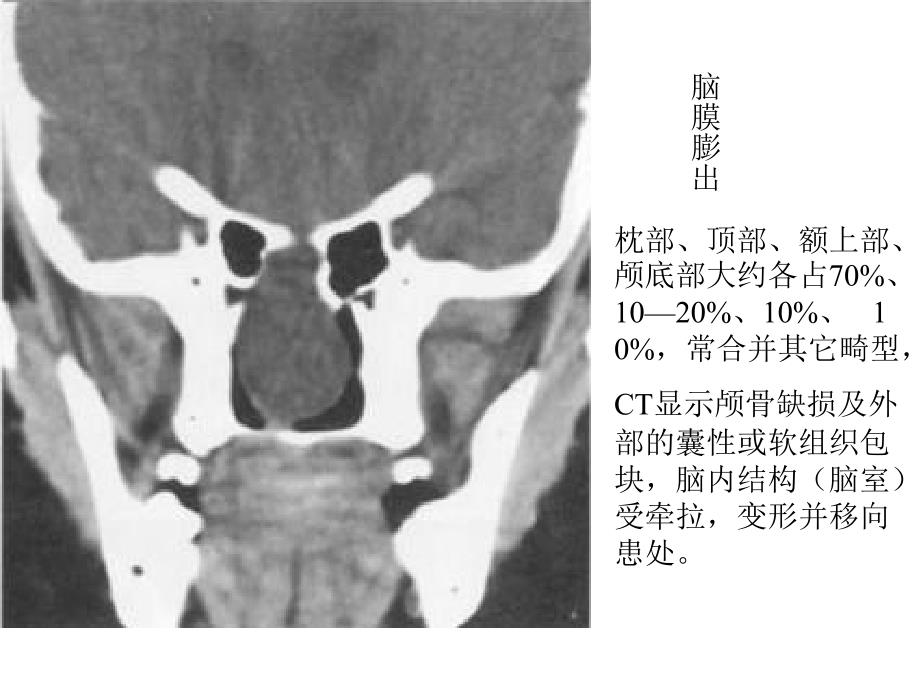 《畸形与脑血管》PPT课件教学文案_第3页