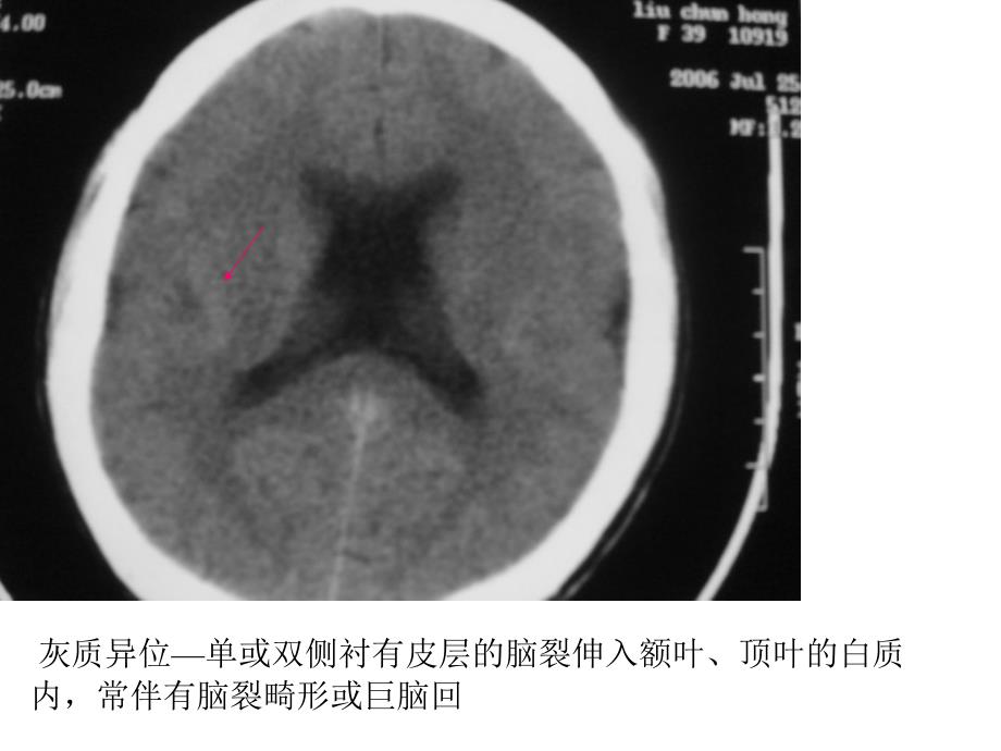 《畸形与脑血管》PPT课件教学文案_第4页