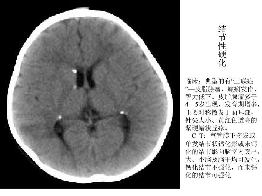 《畸形与脑血管》PPT课件教学文案_第5页