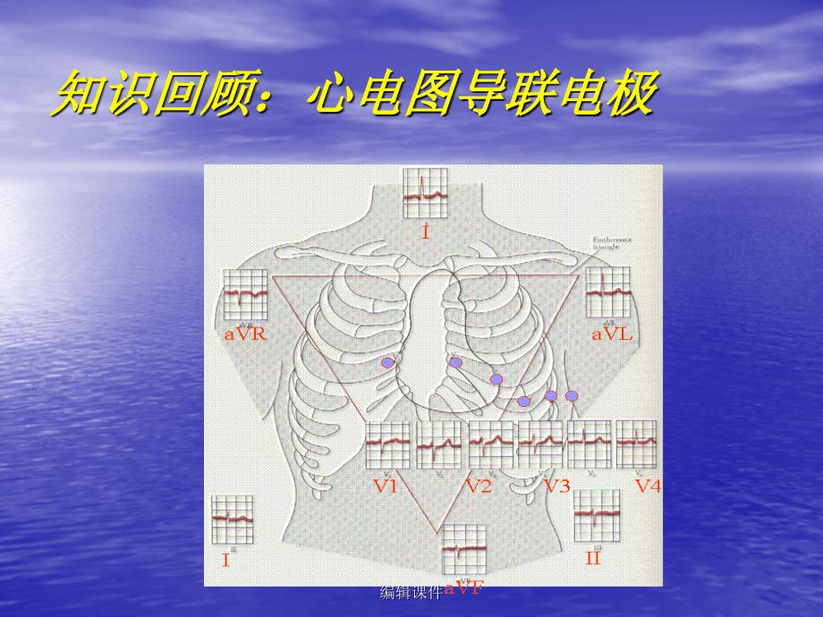 常见心脏疾病心电图诊断ppt课件_第3页