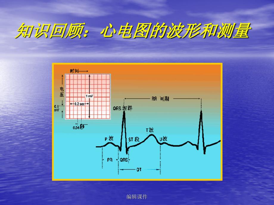 常见心脏疾病心电图诊断ppt课件_第4页