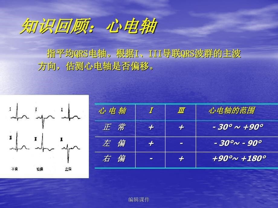 常见心脏疾病心电图诊断ppt课件_第5页