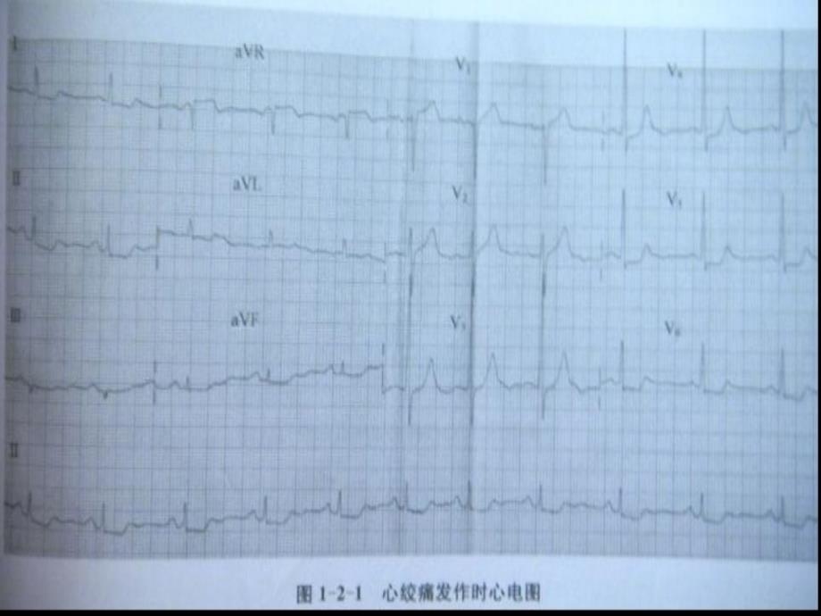 心绞痛、变异性心绞痛的心电图_第4页