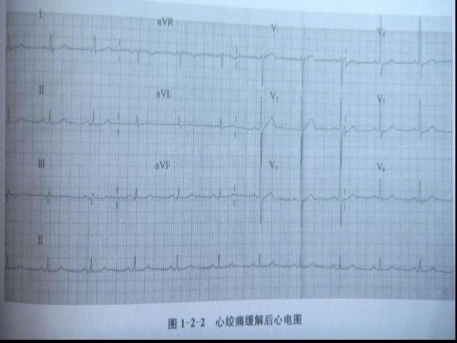 心绞痛、变异性心绞痛的心电图_第5页