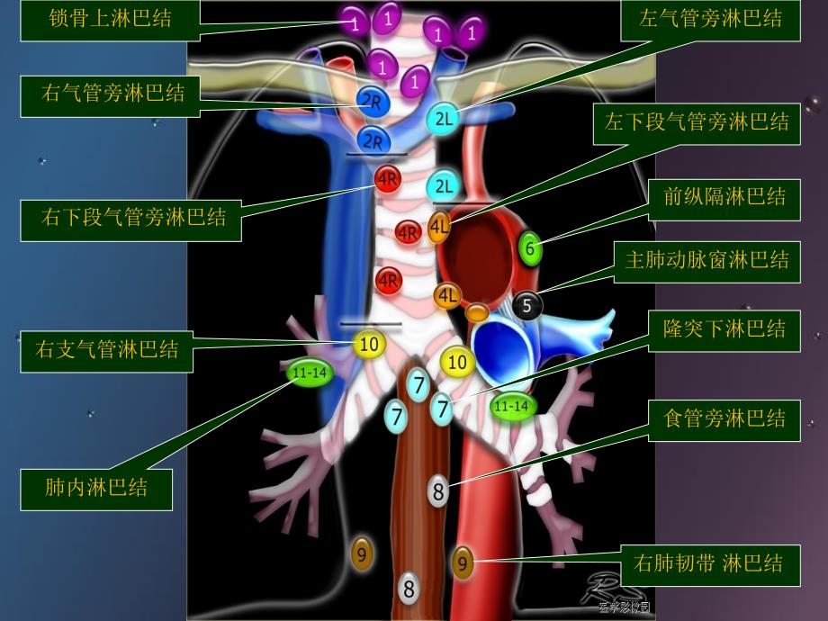 肺癌纵膈肺门淋巴结分区及CT图像PP课件_第3页