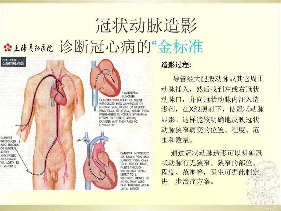 冠心病的介入治疗_第5页