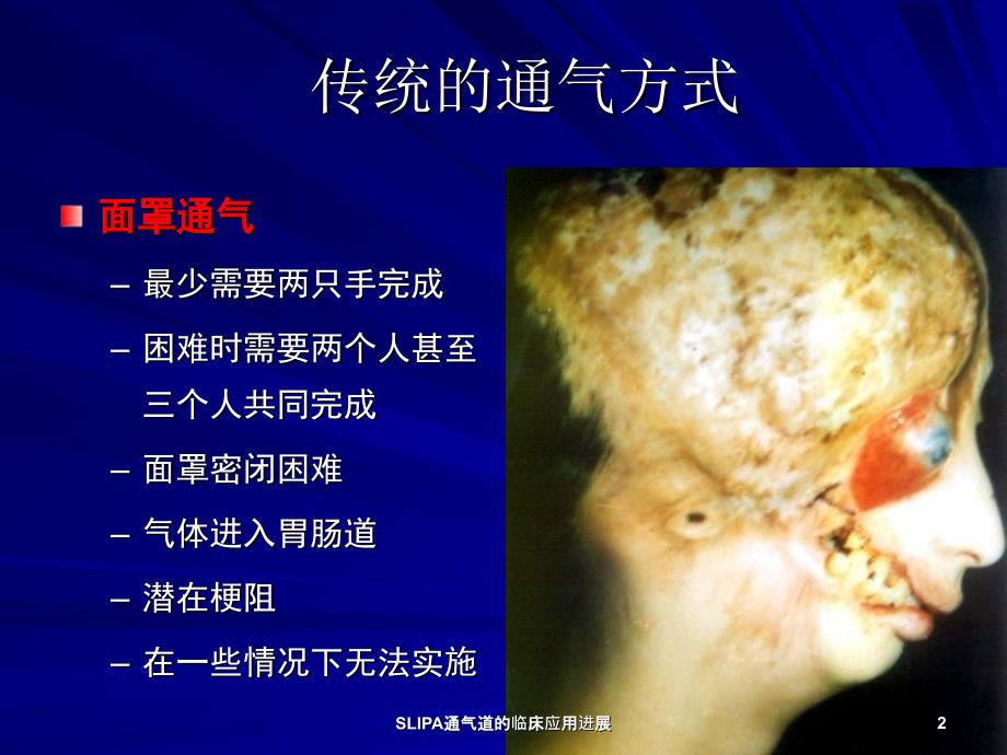 SLIPA通气道的临床应用进展课件_第2页