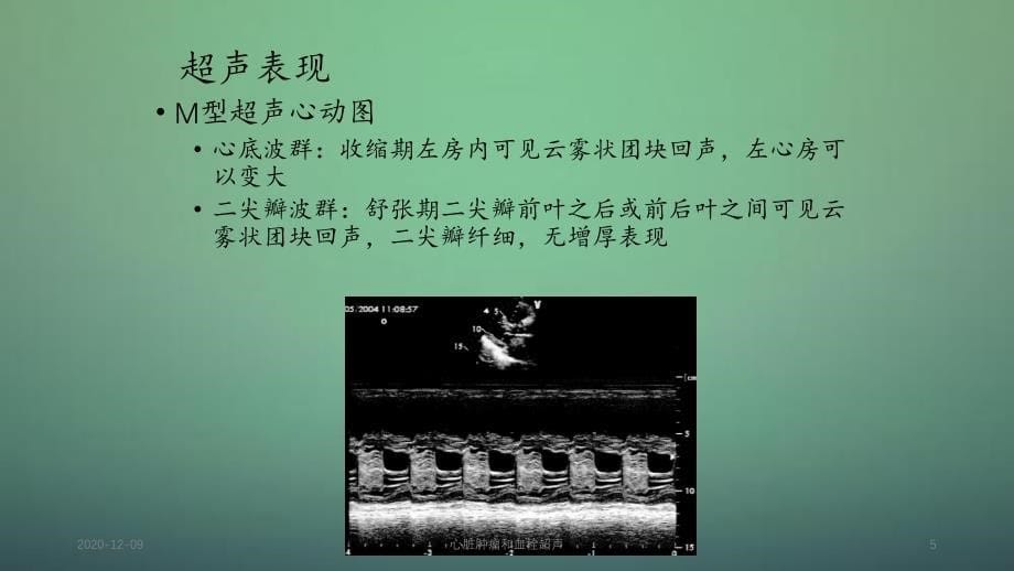 心脏肿瘤和血栓超声_第5页