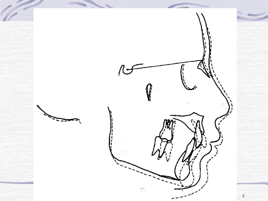 X线头影测量学ppt课件_第4页