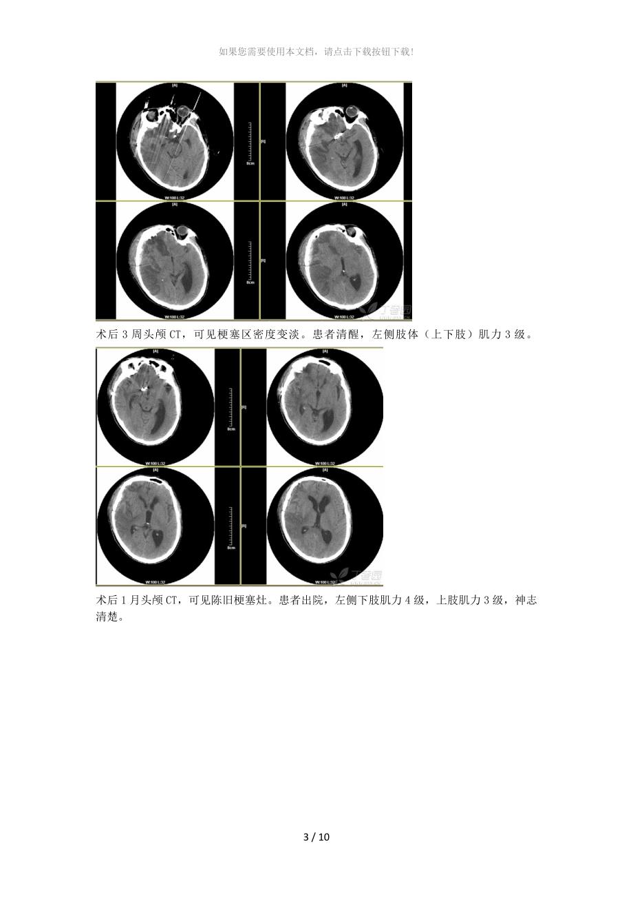 脑血管痉挛CVS_第3页