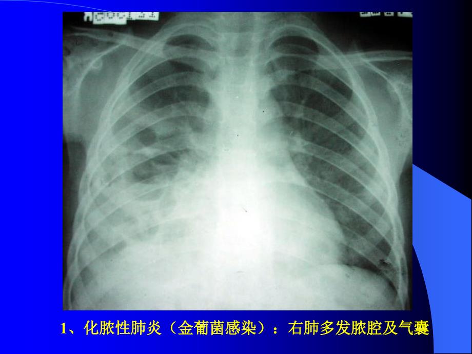 11[1].23胸部X片、CT读片_第1页