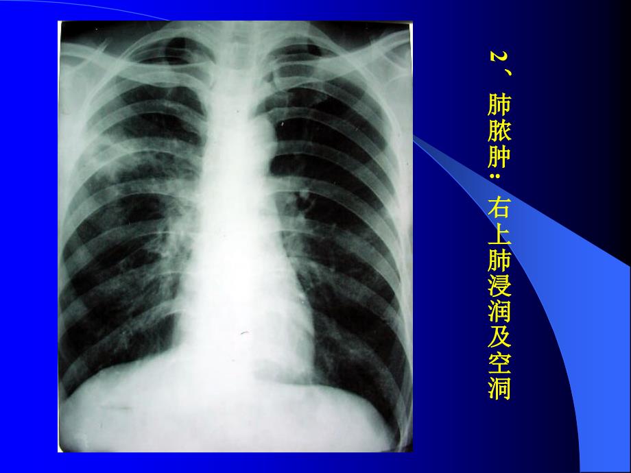 11[1].23胸部X片、CT读片_第3页