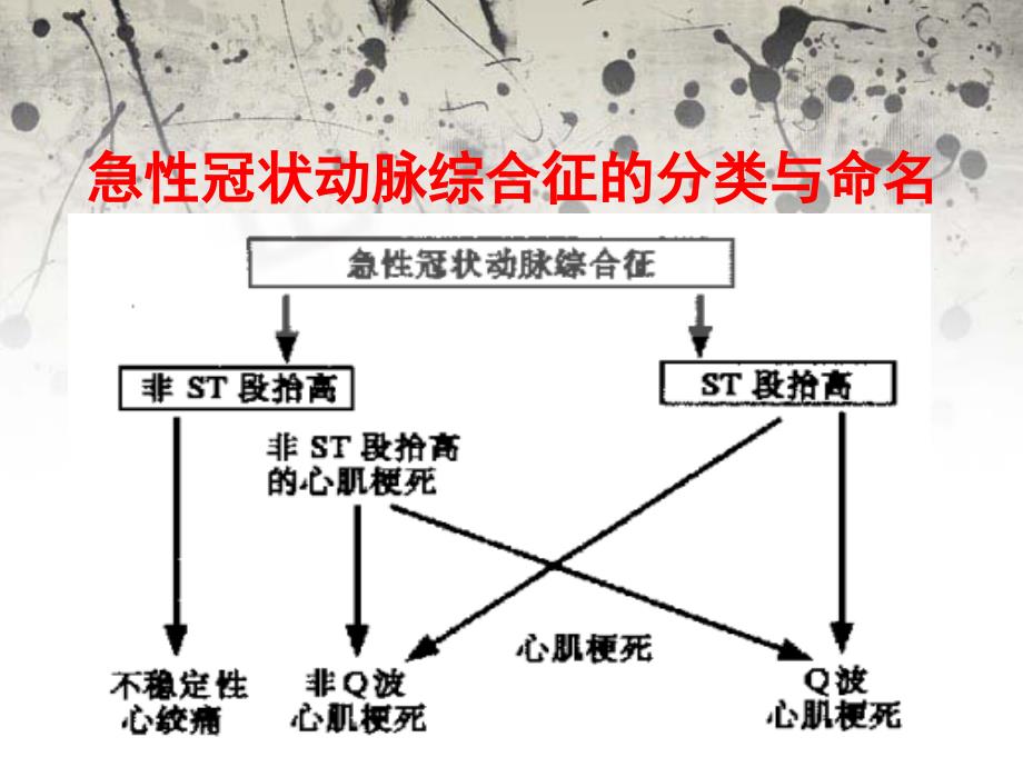 急性冠状动脉综合征 ppt课件_第3页