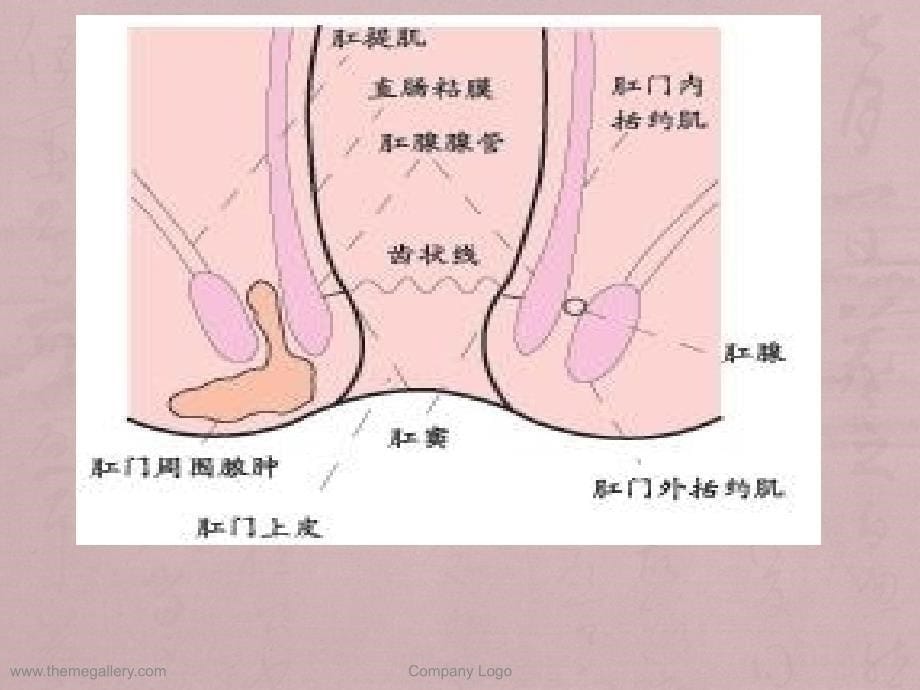 直肠、肛管良性疾病病人的护理_第5页