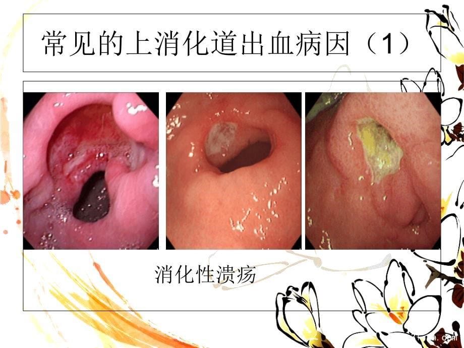 急性非静脉曲张性上消化道出血资料_第5页