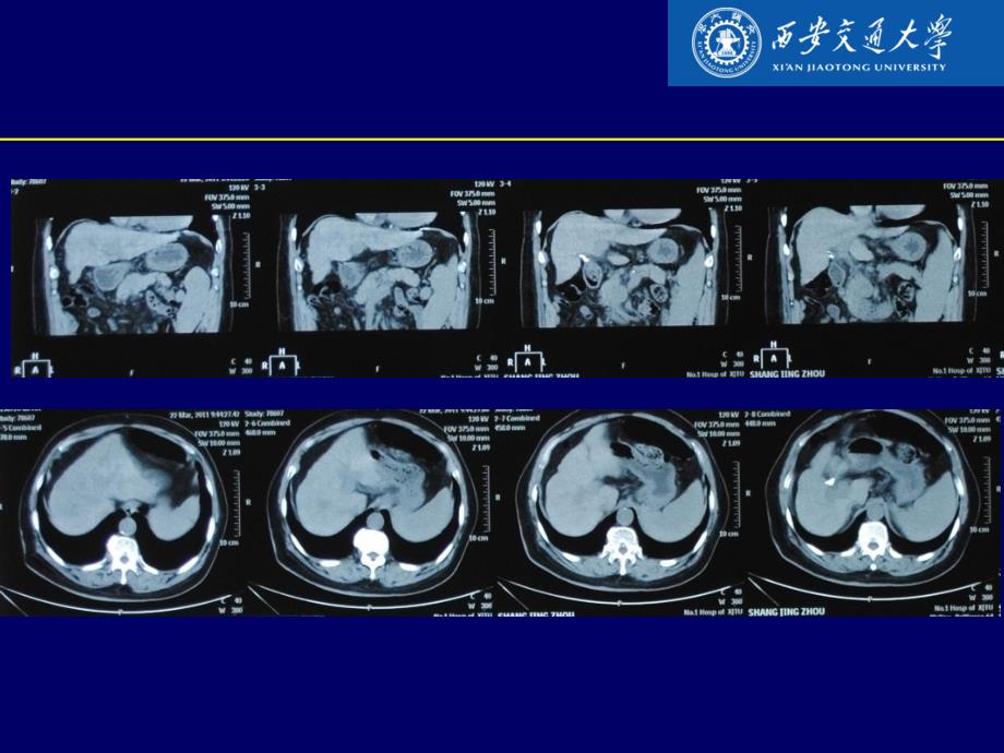 血清病毒低水平代偿期肝硬化课件文档资料_第3页