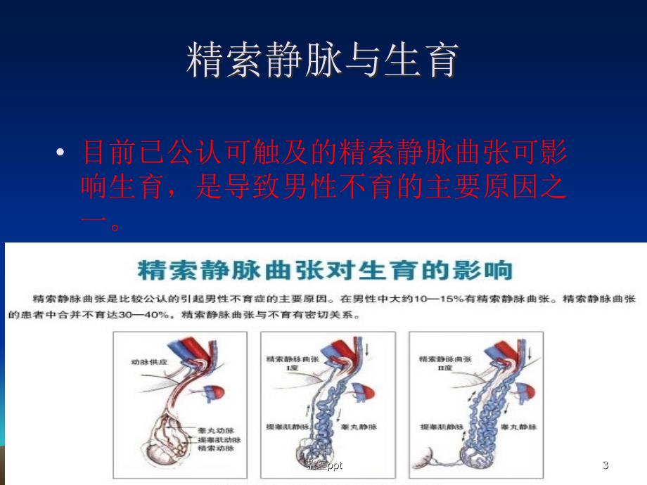 精索静脉曲张的诊断与治疗_第3页