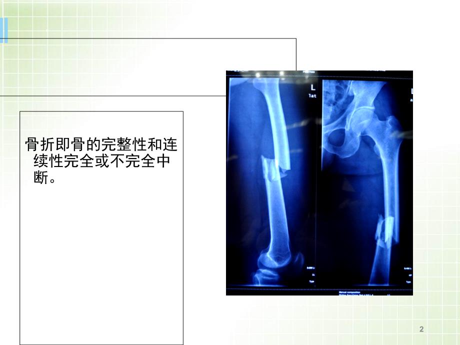 优质医学骨折X线_第2页