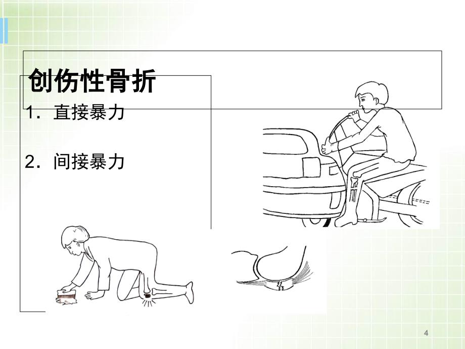 优质医学骨折X线_第4页