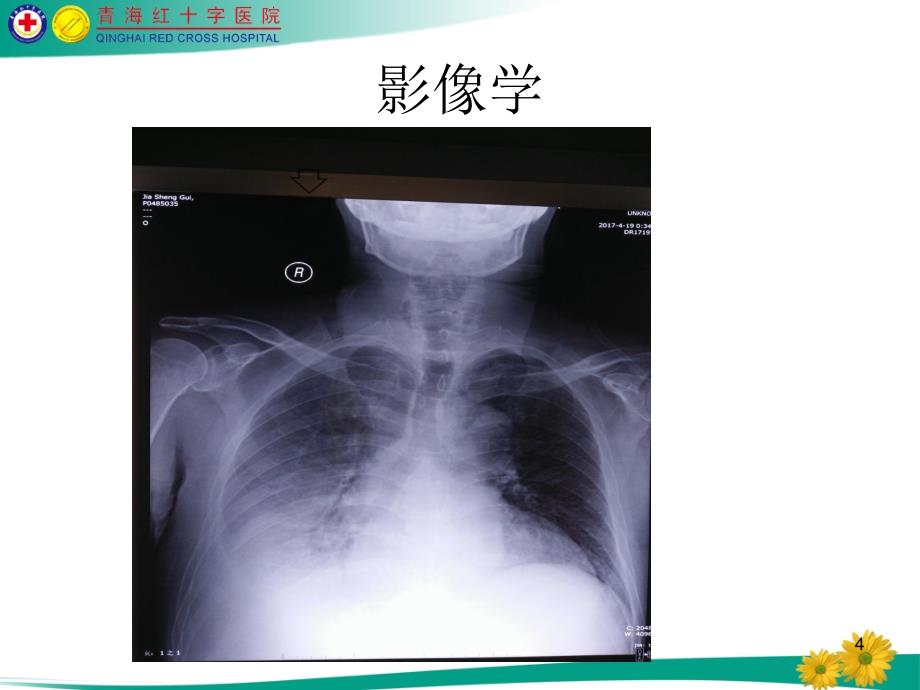 肝性脑病教学查房课件_第4页